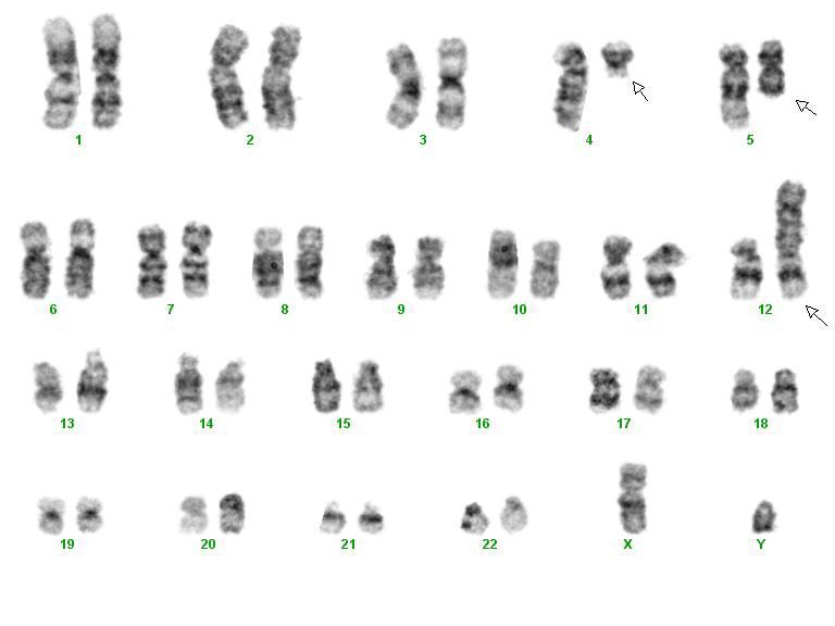 Figure 5. Karyotype. Reciprocal translocation between chromosome 4q12 and 12p13, resulting in fusion of PDGFRα and ETV6, and deletion of 5q.